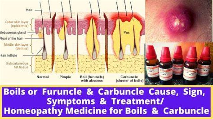How to cure furunculosis?