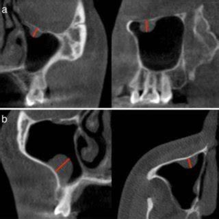 Should a mucous retention cyst be removed?